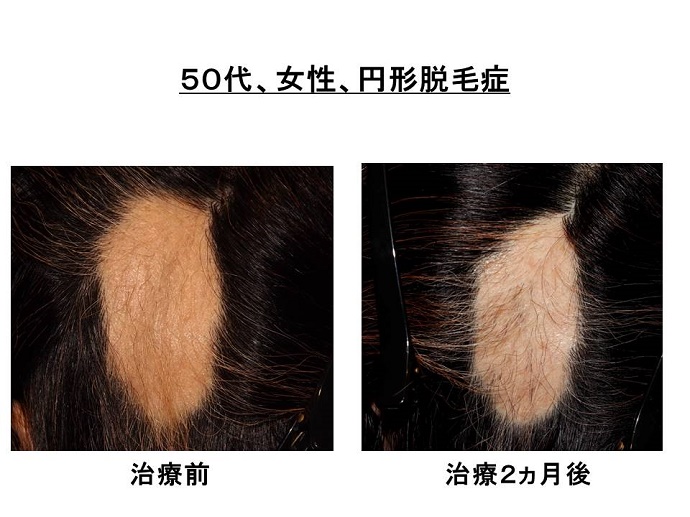 円形脱毛症　病院